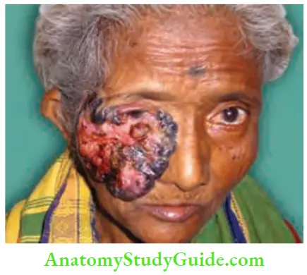 Differential Diagnosis Of Leg Ulcer And Pressure Sore Raised Edged Basic Cell Carcinoma