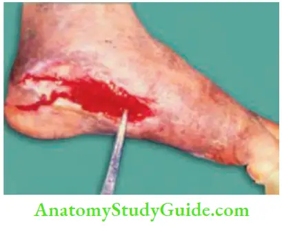 Differential Diagnosis Of Leg Ulcer And Pressure Sore Red Granulation Tissue Healing After Control Of Diabetes And Regular Dressings