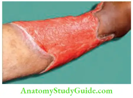 Differential Diagnosis Of Leg Ulcer And Pressure Sore Sloping Edge