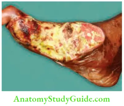 Differential Diagnosis Of Leg Ulcer And Pressure Sore Slough Dead Soft Tissue Typical Spreading Ulcer In A Diabetic Patient