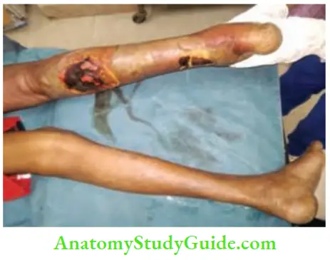Differential Diagnosis Of Leg Ulcer And Pressure Sore Stage 3 Wherein Necrotizing Fasciitis Has Occurred