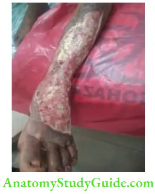 Differential Diagnosis Of Leg Ulcer And Pressure Sore Status Post Debridement