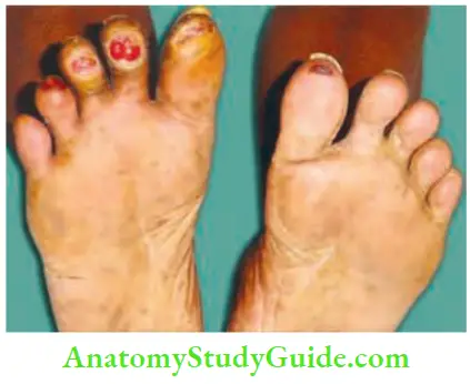 Differential Diagnosis Of Leg Ulcer And Pressure Sore This Patient Had Heat Burns Following Barefoot Walking Resulting In Ulcers