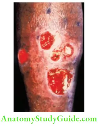 Differential Diagnosis Of Leg Ulcer And Pressure Sore Traumatic Multiple Ulcers Over The Skin Classical Site