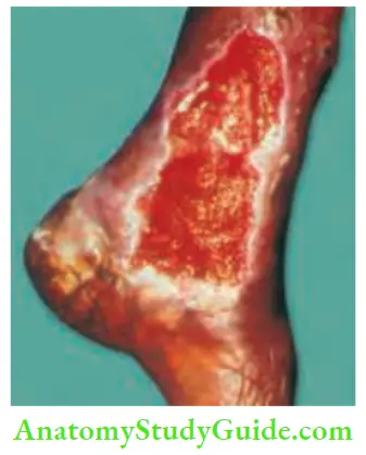 Differential Diagnosis Of Leg Ulcer And Pressure Sore Traumatic ulcer With Red Granulation Tissue In The Floor Typical Healing Ulcer