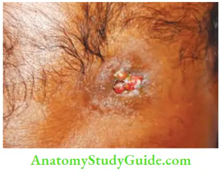 Differential Diagnosis Of Leg Ulcer And Pressure Sore Undermined Edged Tubercular Sinus