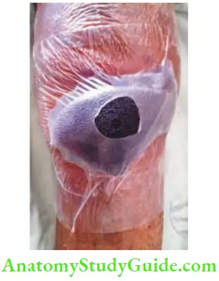 Differential Diagnosis Of Leg Ulcer And Pressure Sore Vacuum Assisted Closure Therapy