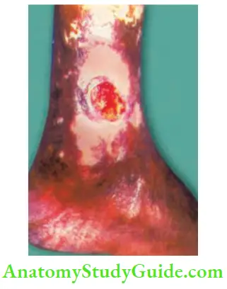 Differential Diagnosis Of Leg Ulcer And Pressure Sore Varicose Ulcer Pigmentation Is Characteristic