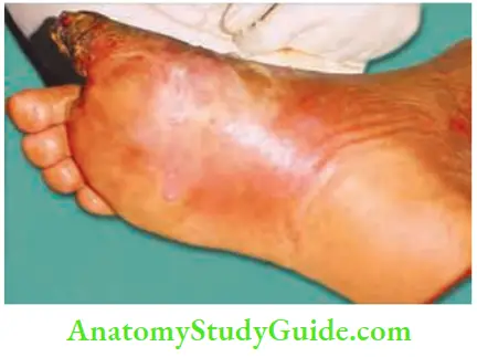 Differential Diagnosis Of Leg Ulcer And Pressure Sore Wet Gangrene With Abscess Foot