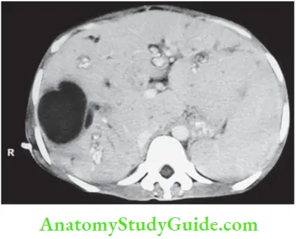 Gallbladder And Pancreas Caroli’s disease showing large cyst and intrahepaticdilation