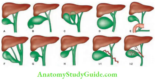 Acute Cholecystitis - Symptoms, Causes and Treatment - Anatomy Study Guide