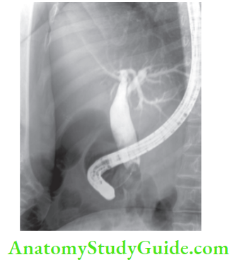 Gallbladder And Pancreas ERCP showing choledochal cyst type 3 treated by sphincterotomy