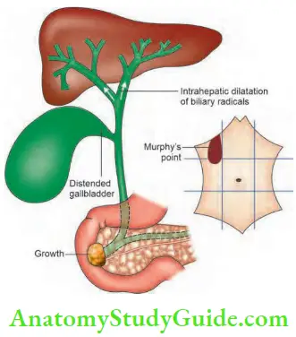 Gallbladder And Pancreas Enlarged palpable gallbladder in cases of periampullary carcinoma