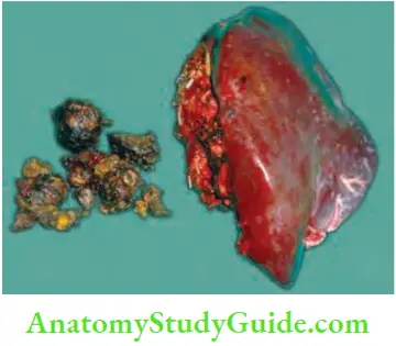 Gallbladder And Pancreas Left lobectomy with extraction of stone Caroli’s disease
