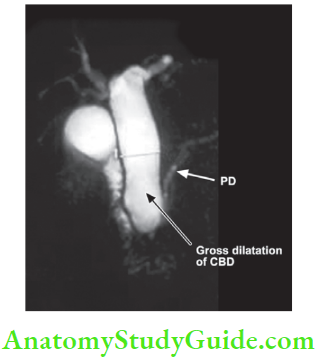 Gallbladder And Pancreas MRC showing choledochal cyst