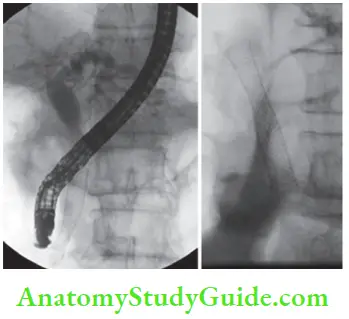 Gallbladder And Pancreas Pallaiative stening for carcinoma head of the pancreas