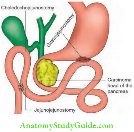 Gallbladder And Pancreas Palliative triple bypass