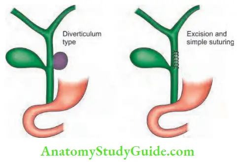Gallbladder And Pancreas Type 2 excision and suturing