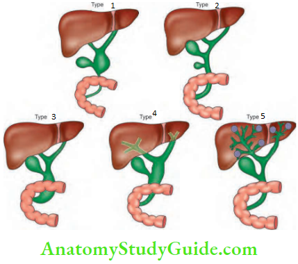 Gallbladder And Pancreas Types of choledochal cysts