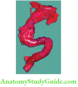 Gallbladder And Pancreas Whipple’s resection specimen