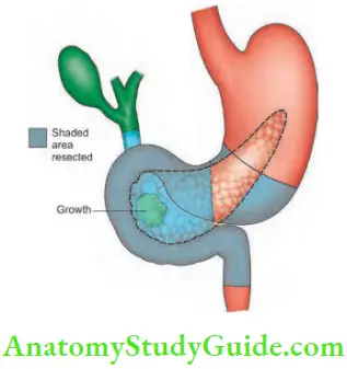 Gallbladder And Pancreas Whipple’s resection