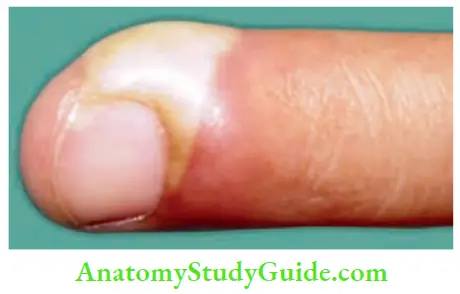 Hand Foot Infections And Tendon Transfer Acute Paronychia Very Painful Condition, can be Treated Very Easily