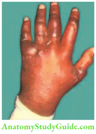 Hand Foot Infections And Tendon Transfer Grossly Swollen Hand In A Diabetic Patient.