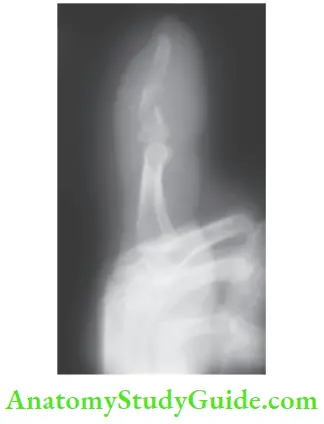 Hand Foot Infections And Tendon Transfer Plain Radiography Of Hand Showing Osteomyelitis Of Terminal Phalanx