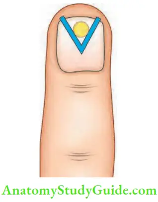 Hand Foot Infections And Tendon Transfer V Excision Of The Nail, For Apical Infection