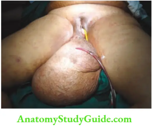 Hernia A large perineal hernia was diagnosed To have a barthalins cyst and was exploxed by a gynaecologist