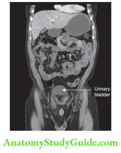 Hernia CECT Scan
