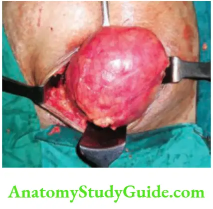 Hernia Delivery Of The Sac