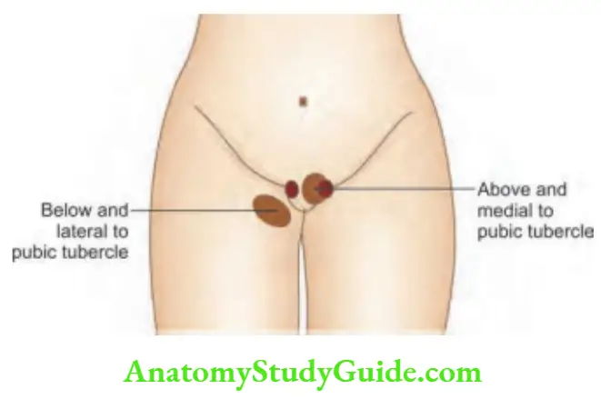 Hernia Fermoral Hernia And Indirect HErnia
