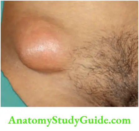 Hernia Iliopsoas abscess
