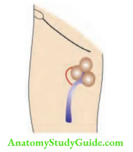 Hernia Lymphadenitis