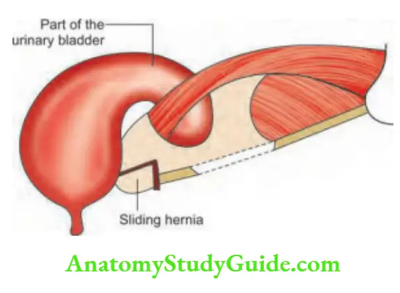 Hernia Siliding Hernia