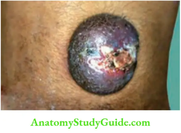 Hernia Umbilical Hernia In A Cirrhotic Patient With Skin Chages And Ulceration