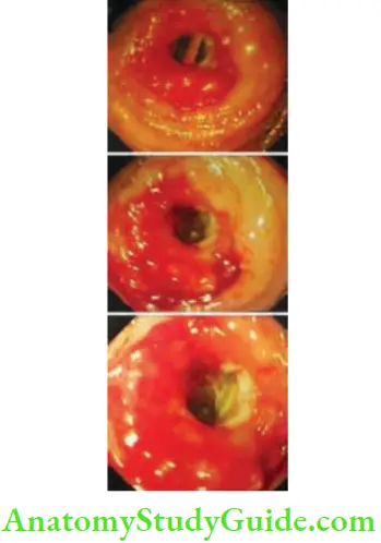 Intestinal Obstruction Balloon Enterscopy Showing Jejunal Ulcers