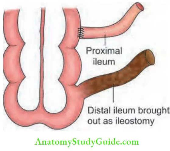 Atresia And Stenosis: Types, Diagnosis & Treatment - Anatomy Study Guide