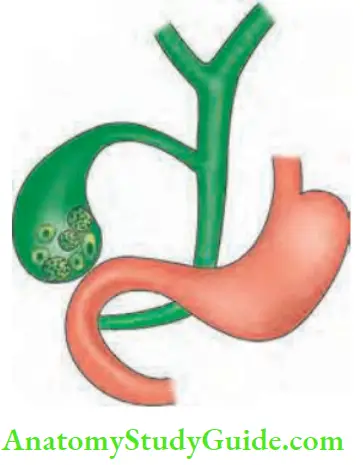Intestinal Obstruction Cholecy Stoduodenal Fistula Caused By Gallstones