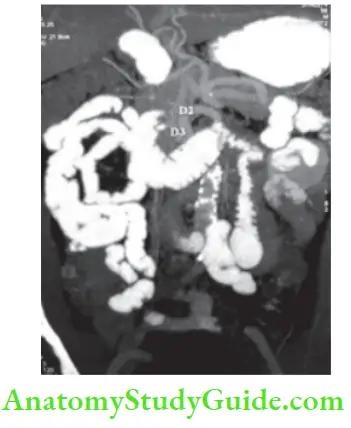 Intestinal Obstruction Enteroclysis Showing Jejunal Narrowing And Aortic