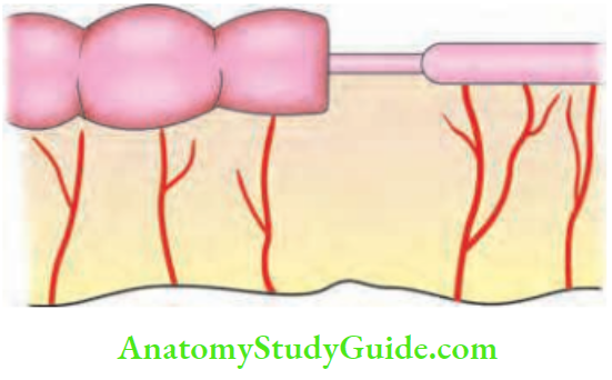 Intestinal Obstruction Gries Field Type 2