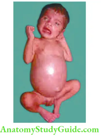 Intestinal Obstruction IIleal Obstruction