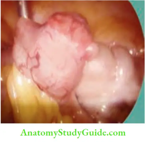 Intestinal Obstruction Laparoscopy Detected A Lesion In The Small Intestine