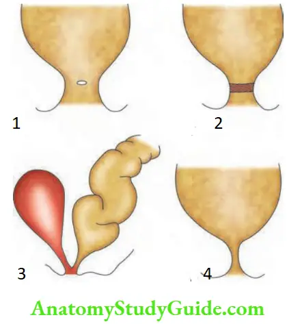 Intestinal Obstruction Low Anorectal Anomalies