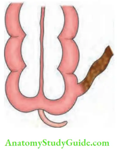 Intestinal Obstruction Meconium Ileus