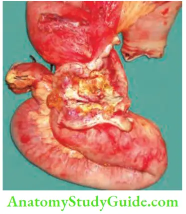 Intestinal Obstruction Peritoneal Metastasis Causing Narrowing Of Lumen Resulting In Obstruction