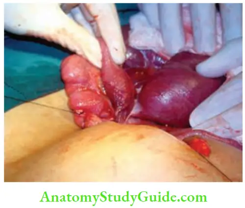 Intestinal Obstruction Pregnant Lady With Adhesions Causing Intestinal Obstruction