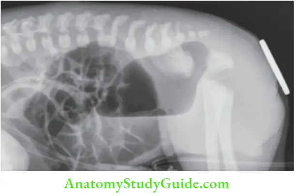 Intestinal Obstruction Prone Position Showing High Anomaly