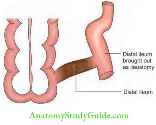 Intestinal Obstruction Santulli Operation